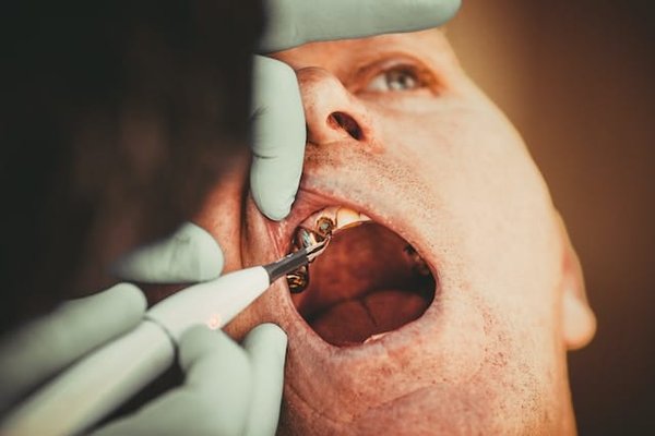Caries dentaires: Causes, conseils de prévention et solutions efficaces