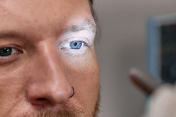 Cataracte : Comprendre, diagnostiquer et traiter cette affection oculaire - Guide essentiel