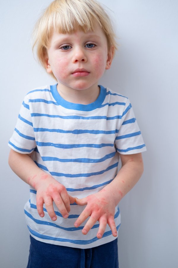 Eczéma au visage : astuces pour une peau éclatante et saine
